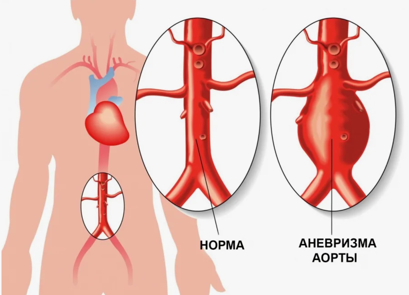 аневризма аорты